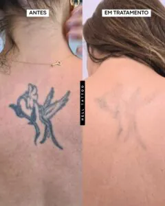 por-que-os-resultados-de-uma-remocao-de-tatuagem-podem-variar