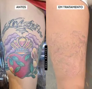 remocao-tatuagem-colorida-paraiba