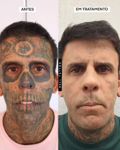 cuidado-com-o-paciente-hell-tattoo-interrompe-temporariamente-remocao-das-tatuagens-de-leandro-de-souza-apos-avaliacao-medica-identificar-alteracao-na-bexiga - Foto: Hell Tattoo