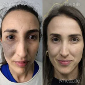 nevo-de-ota-tratamento-a-laser-e-onde-tratar-no-brasil-02