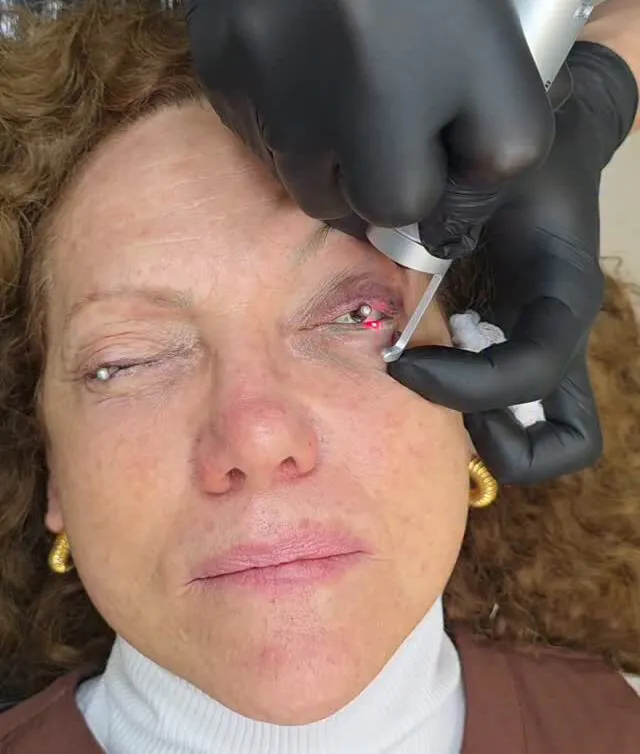 cicatriz-de-acne-cirurgia-ou-queimadura-quando-o-laser-pode-ajudar
