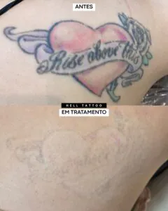 o-tamanho-da-tatuagem-interfere-no-tempo-de-remocao-entenda