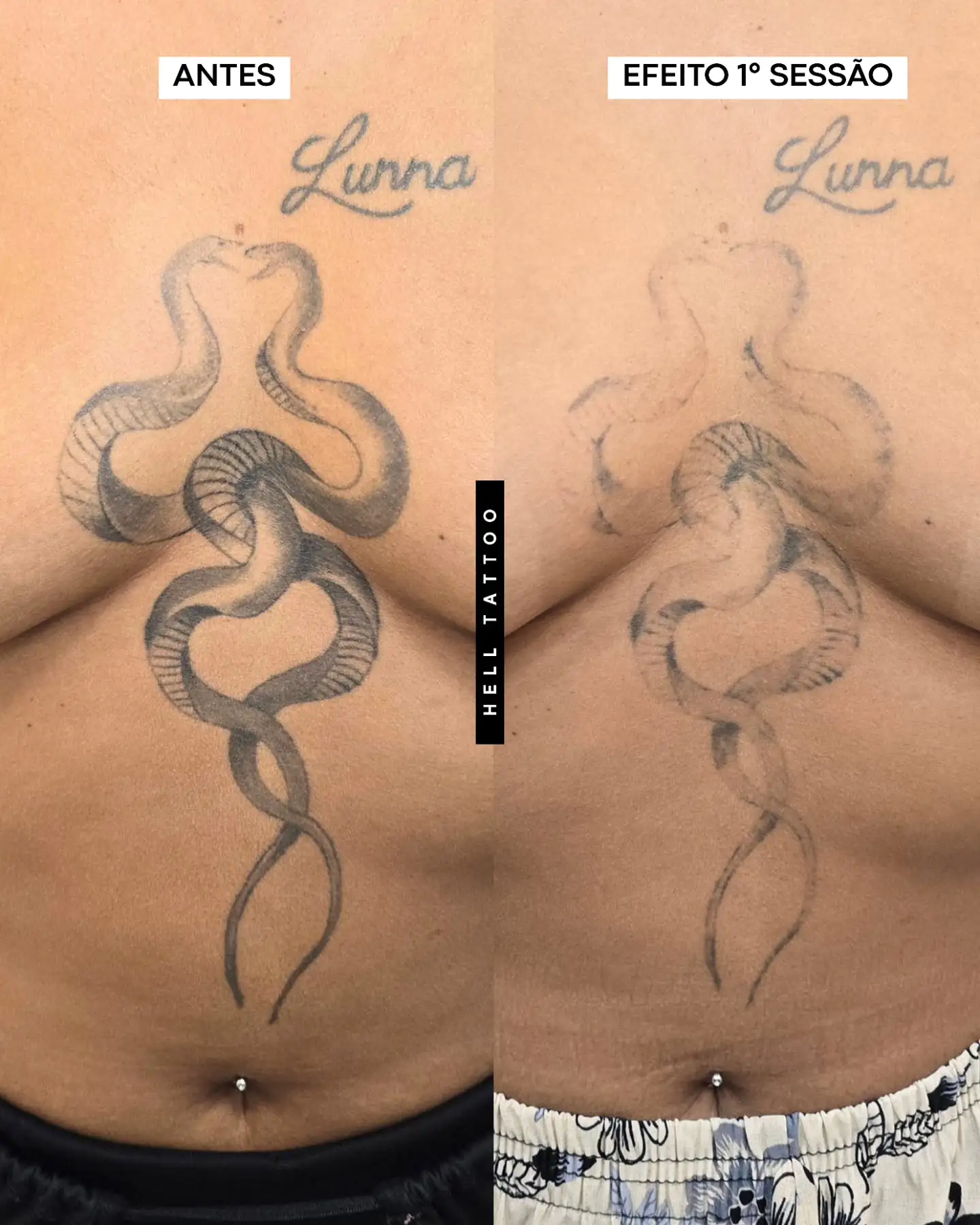 para-onde-vai-a-tinta-da-tatuagem-durante-a-remocao-a-laser