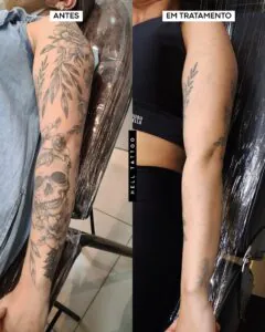 tatuagem-recente-pode-ser-removida-quanto-tempo-esperar