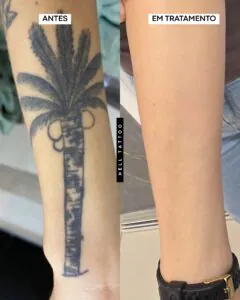 a-tatuagem-ficou-torta-o-laser-consegue-corrigir-02