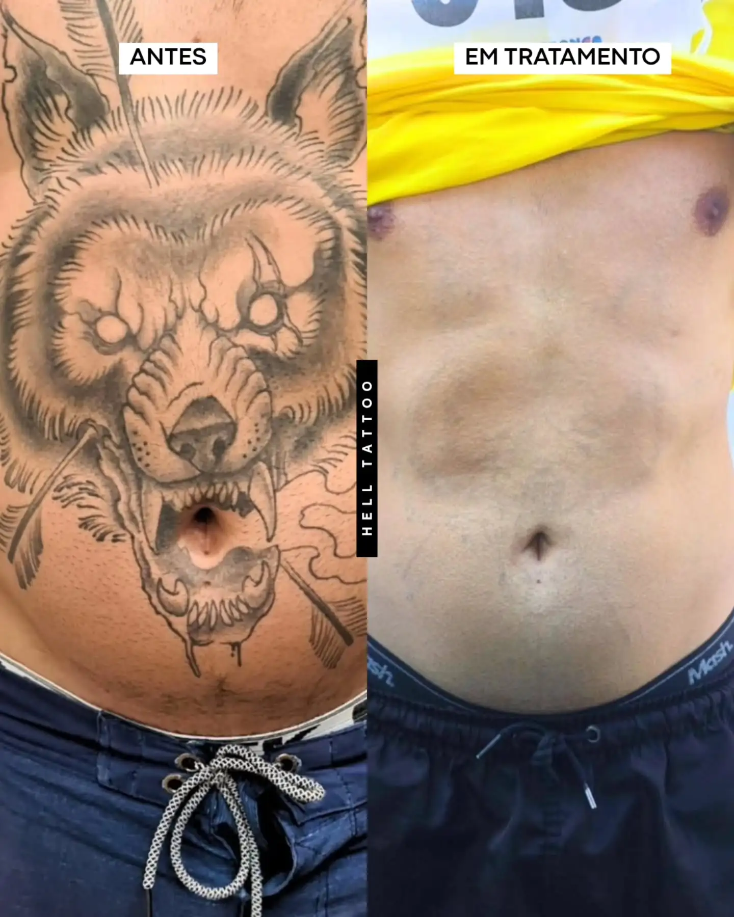o-laser-consegue-remover-toda-a-tinta-de-uma-tatuagem