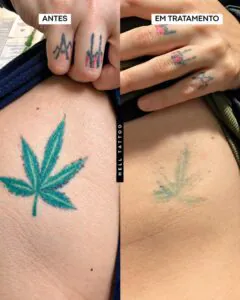 tatuagem-preta-e-outra-colorida-qual-e-mais-facil-de-remover-003