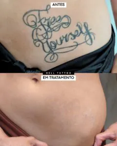 tatuagem-preta-e-outra-colorida-qual-e-mais-facil-de-remover-02