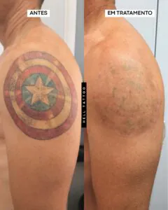 tatuagem-vermelha-sai-com-laser-2