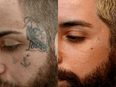 Remoção de tatuagem no rosto